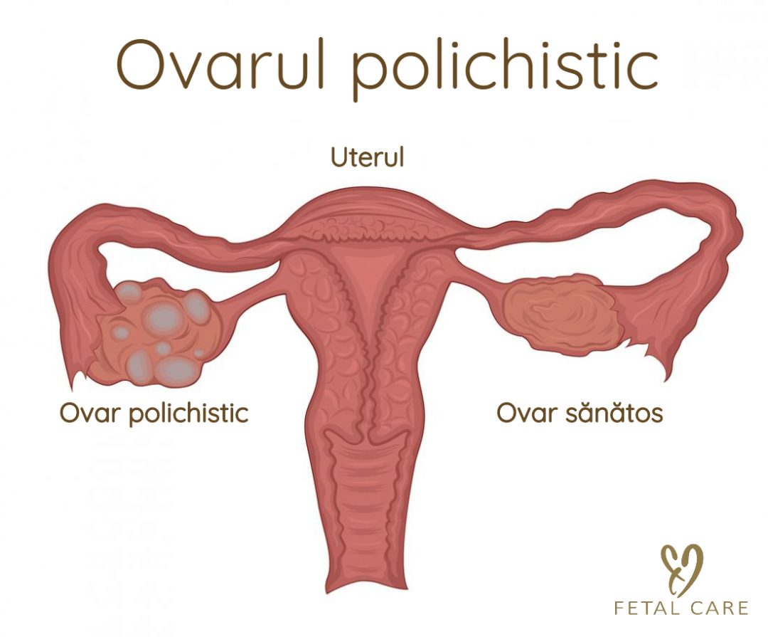 Sindromul ovarelor polichistice – cauze, simptome, tratament